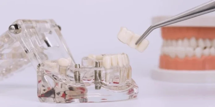 выбор зубного протеза- виды и отличия выбор зубного протеза: виды и отличия